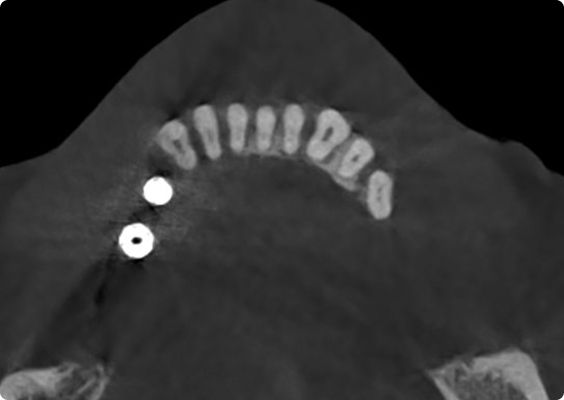 After metal artifact reduction